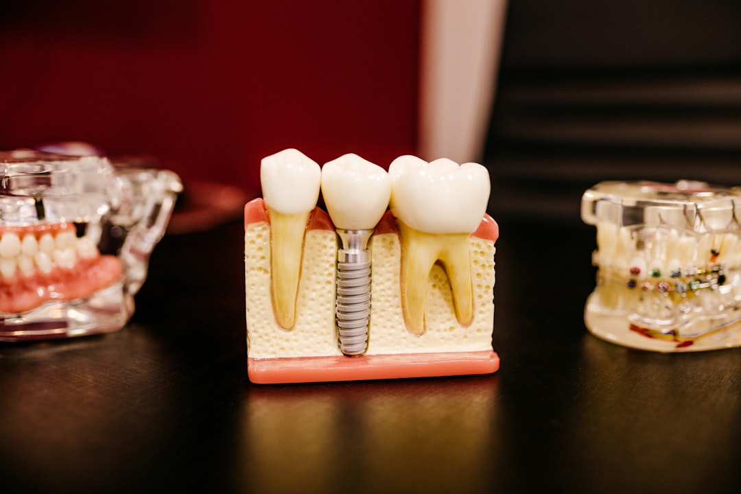 Guia sobre a durabilidade implante dentário em São Luís - MA com dicas de nutrição e higiene bucal.